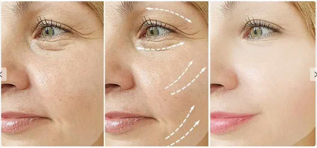 Jalupro Biorevitalizácia
